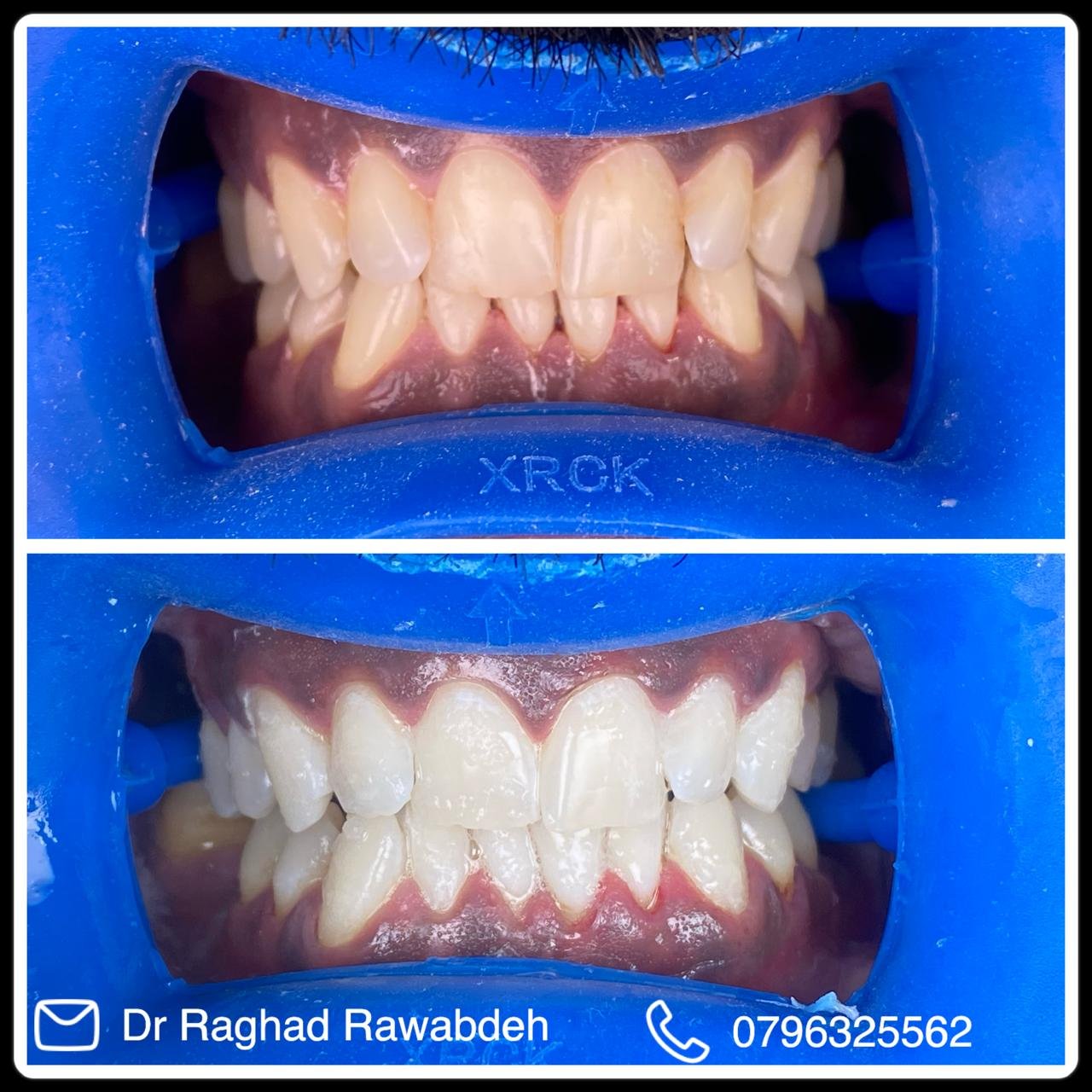 تبييض اسنان باستخدام جهاز الليزر